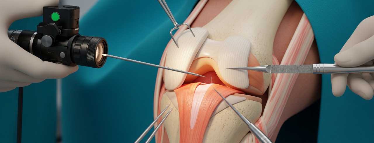 Knee Arthroscopy